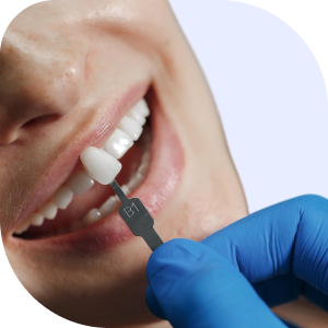 Dental Veneers