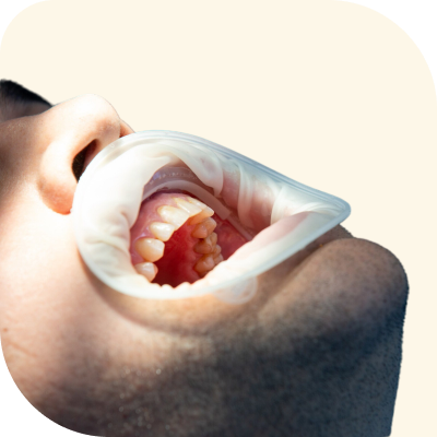 gumtreat