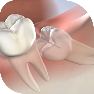 Wisdom Tooth Removal
